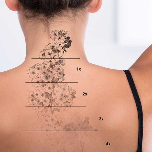 Tattooentfernung auf dem Rücken der Frau
